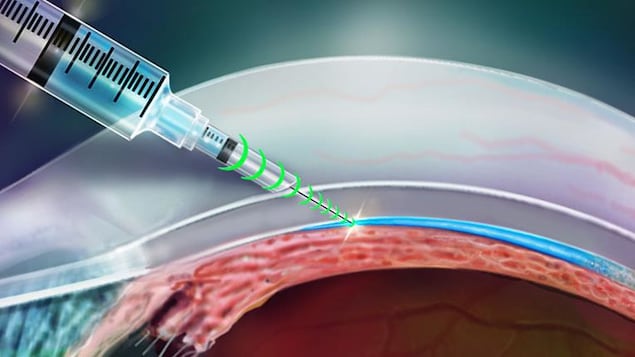 /forum/uploads/images/1551/aiguille-i2t2-illustration-injection-oeil.jpg