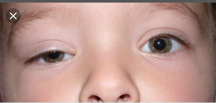 Ptosis Ptosis