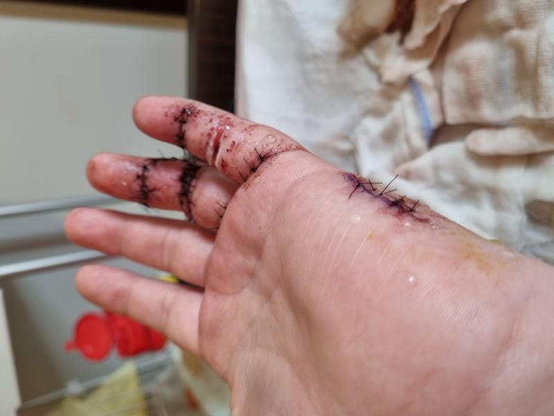 35 points de suture et greffe de peau